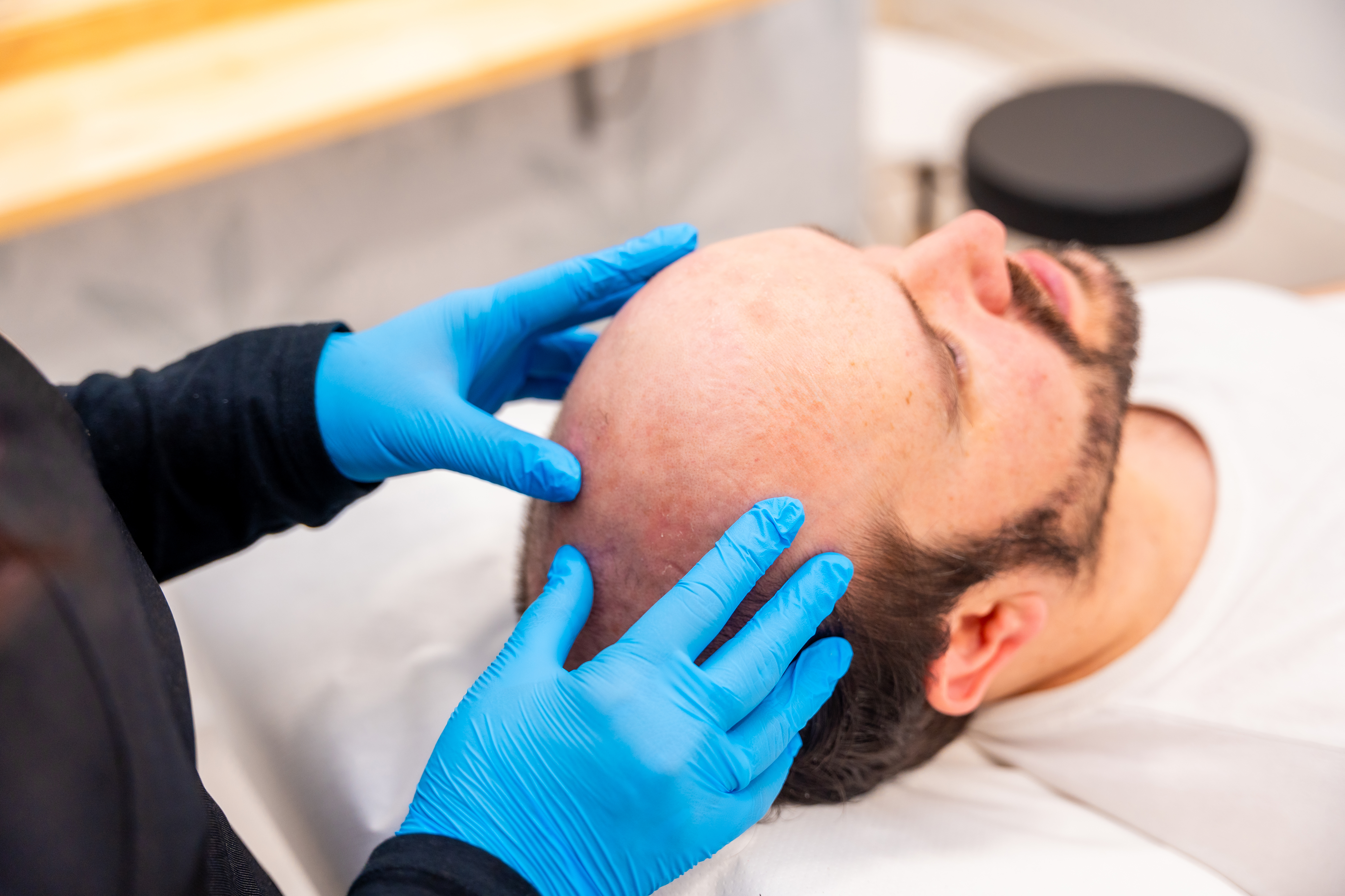 Complete Baldness SMP Treatment